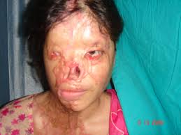 acid attack